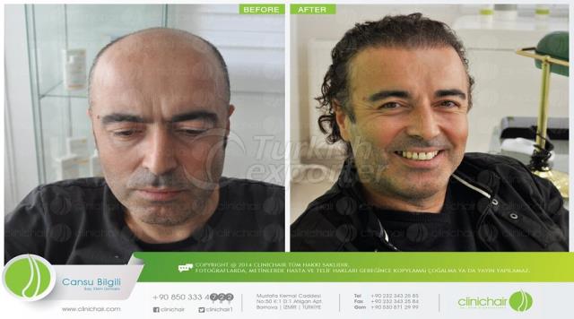 FUE Hair Transplant